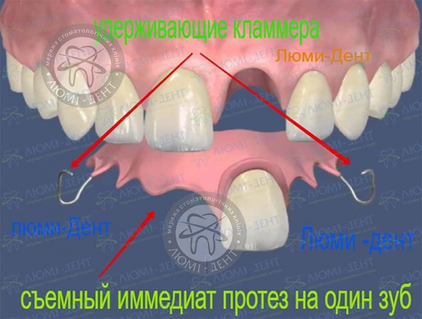 Съемный иммедиат протез на один зуб фото Люми-Дент