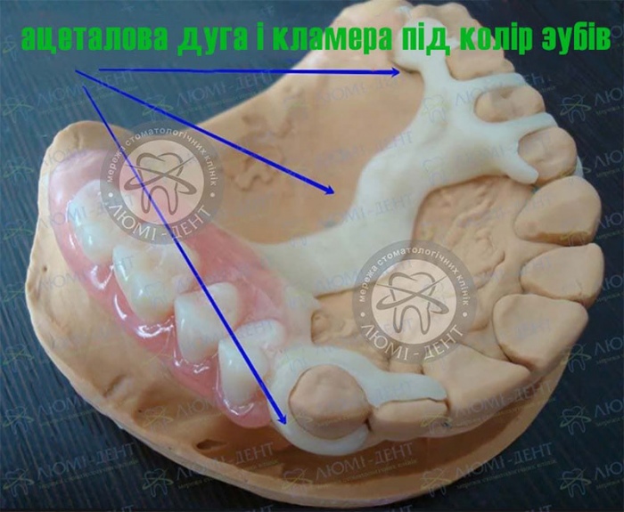 Часткові знімні протези стоматологія фото Люмі-Дент