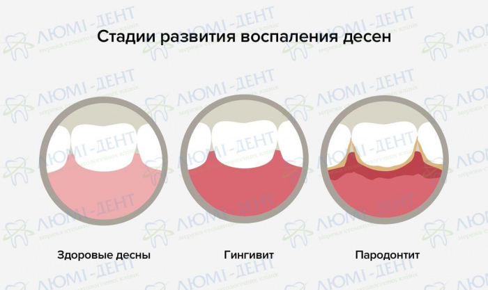 лечение десен лекарства фото ЛюмиДент