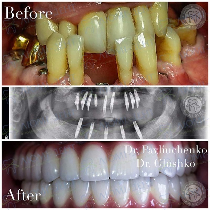 Нет всех зубов поставить импланты в Киеве фото Люми-Дент
