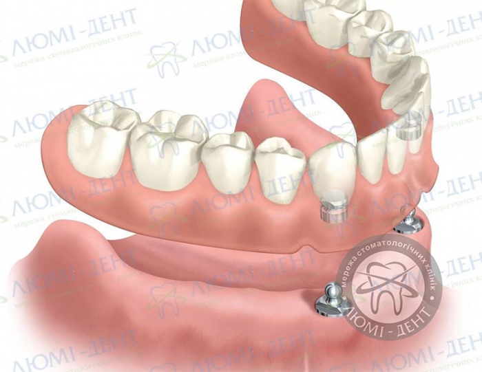 Вирвано всі зуби взагалі що робити вставити імпланти фото Люмі-Дент