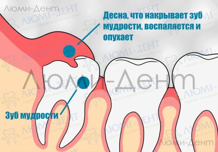 Воспаление десны Удаление зуба мудрости фото Люми-Дент