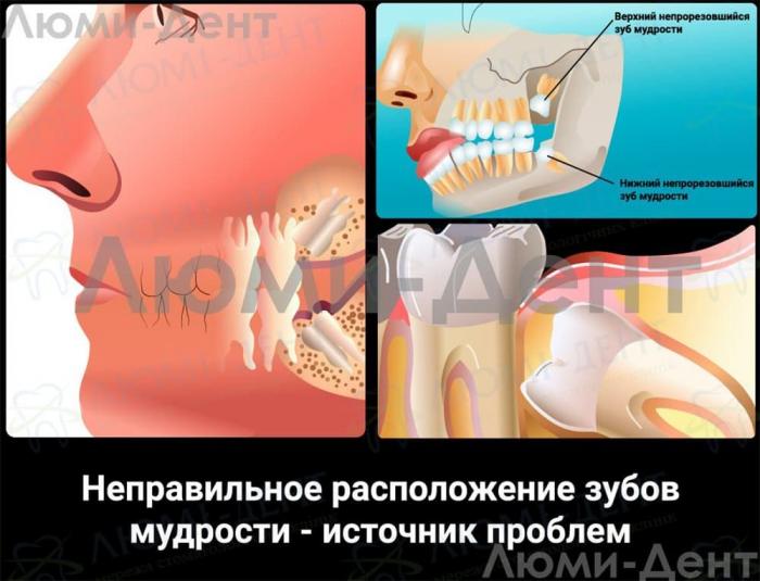 Расположение восьмерок Удаление зубов мудрости фото Люми-Дент