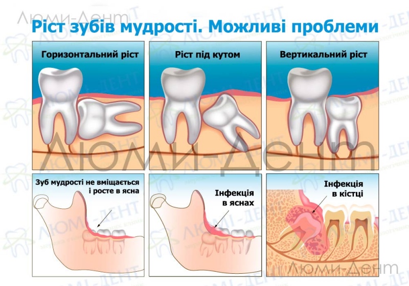 болить зуб мудрості фото Люмі-Дент