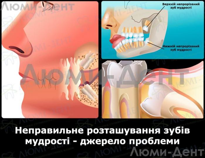 Розташування вісімок Вилучення зубів мудрості фото Люмі-Дент