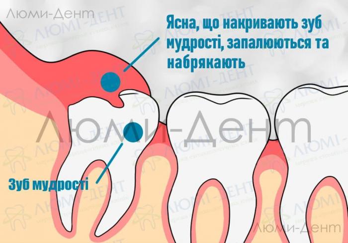 Запалення ясен Видалення зуба мудрості фото Люмі-Дент