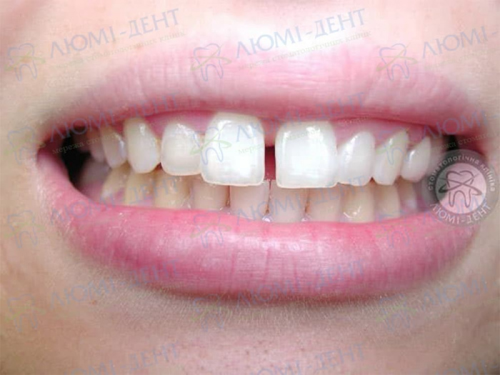 Діастема щілина між зубами фото Люмідент