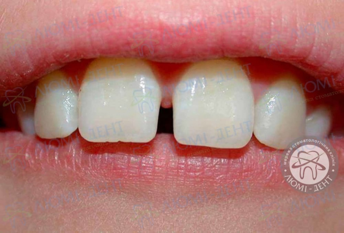 Диастема зубов у детей причины фото Люмидент