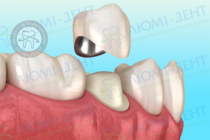 Emax коронка фото Люмі-Дент