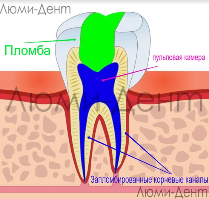 Эндодонтическое лечение зубов фото Люми-Дент