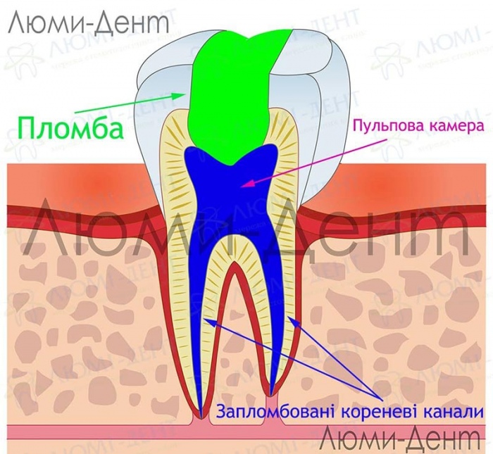 Ендодонтичне лікування зубів фото Люмі-Дент