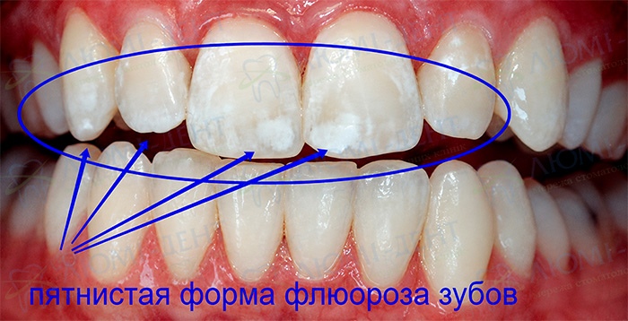 Пятнистая форма флюороза зубов Флюороз эмали зубов фото Люми-Дент