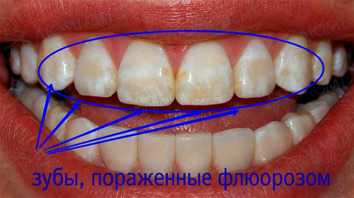Эндемический флюороз зубов Флюороз зубов эмали фото Люми-Дент