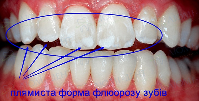 Плямиста форма флюорозу зубів флюороз причини фото Люмі-Дент
