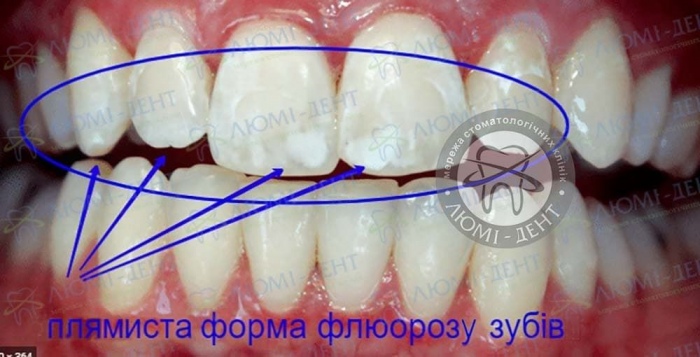 флюороз причини фото Люмі-Дент