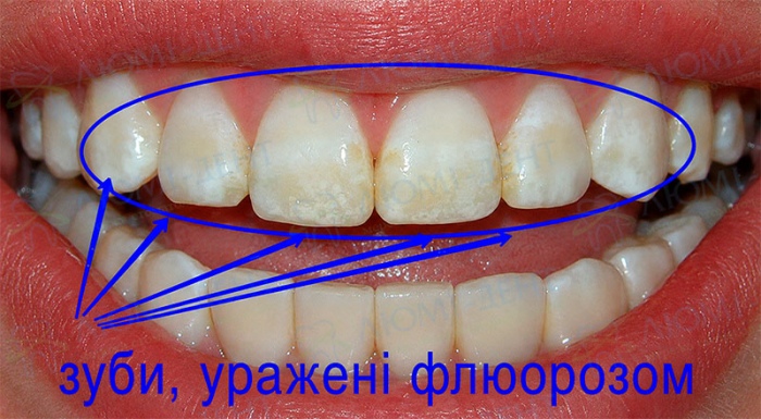 Ендемічний флюороз зубів флюороз зубів фото Люмі-Дент
