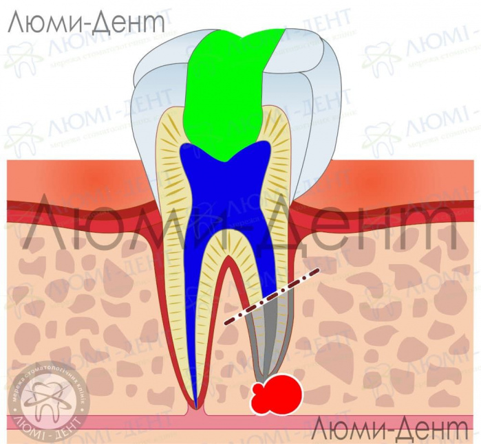 гемисекция зуба фото ЛюмиДент