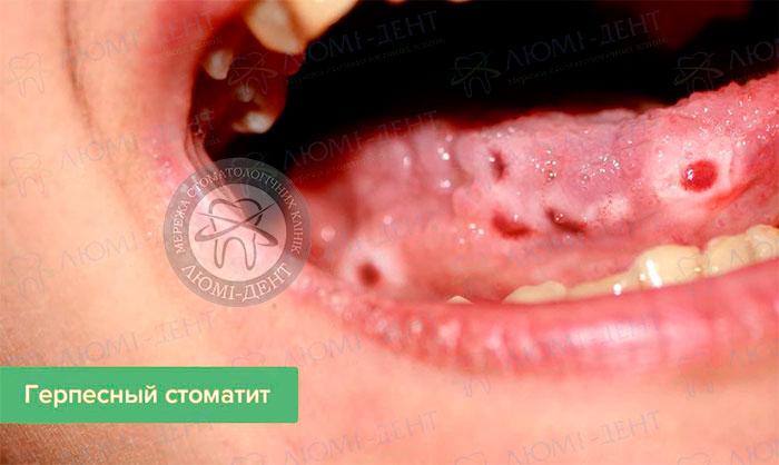 Простуда на языке Простуда на языке фото ЛюмиДент