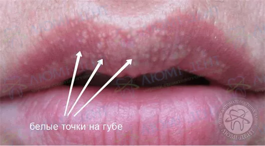 Белая сыпь во на губе Белая сыпь во на губе фото Люмидент