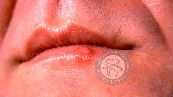 Герпес на губі лікування фото Люмі-Дент