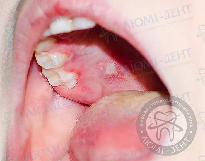 Лікування герпесу у роті фото ЛюміДент