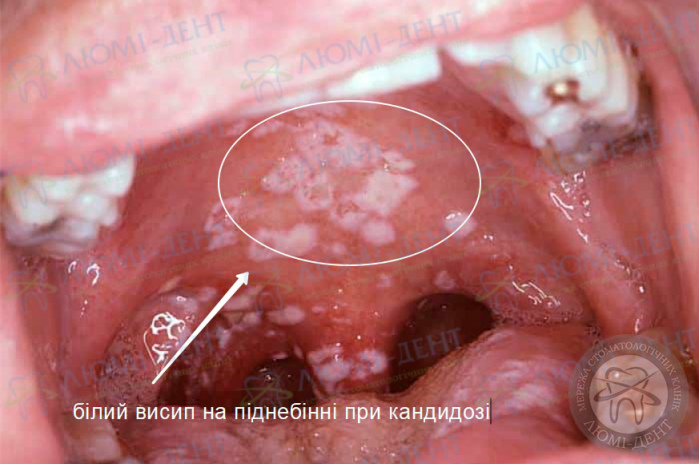 Білий висип на піднебінні фото Люмідент