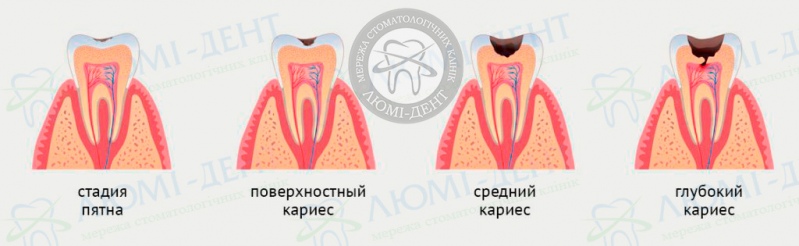 глубокий кариес фото Люми-Дент