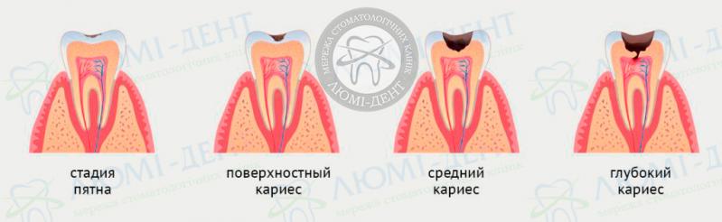Стадии развития глубокого кариеса Глубокий кариес фото Люми-Дент