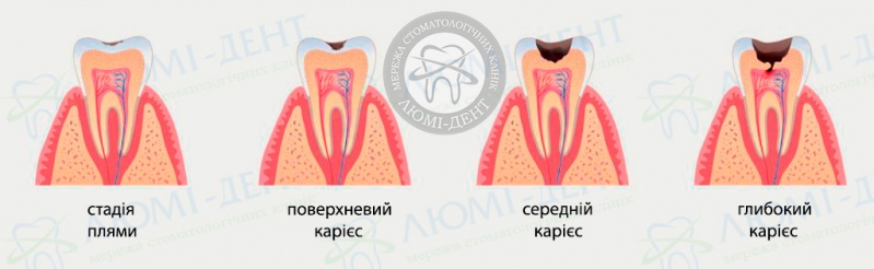 гострий глибокий карієс фото Люмі-Дент