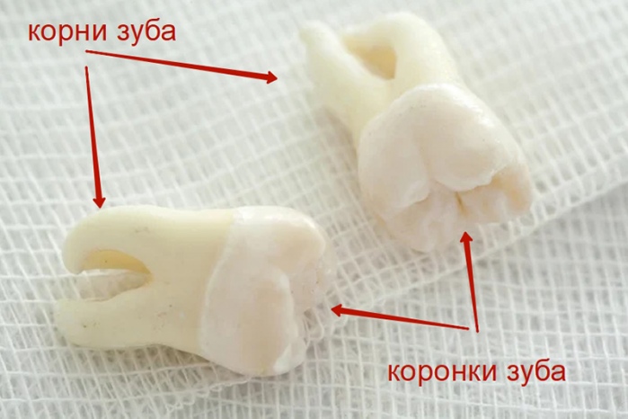 Вырванный зуб мудрости фото Люми-дент