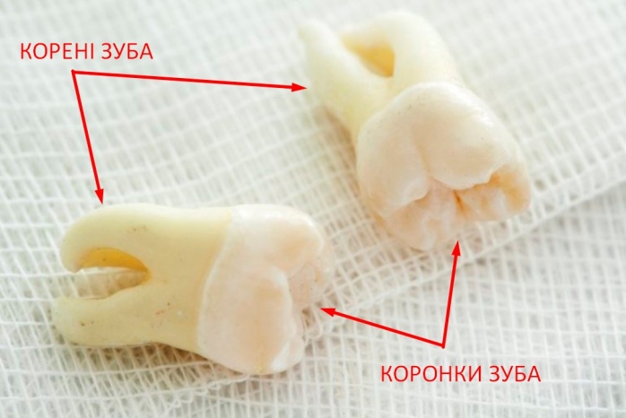 Вирваний зуб мудрості фото Люмі-дент