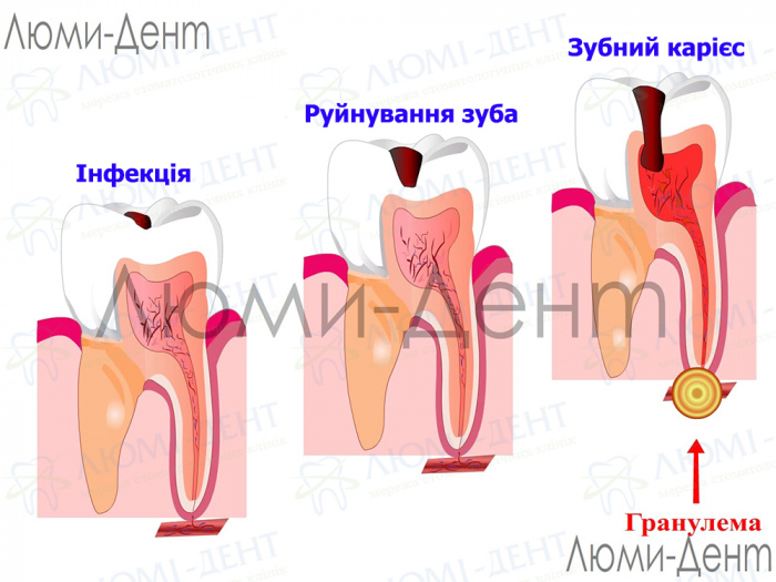 Гранулема зуба фото Люмі-Дент