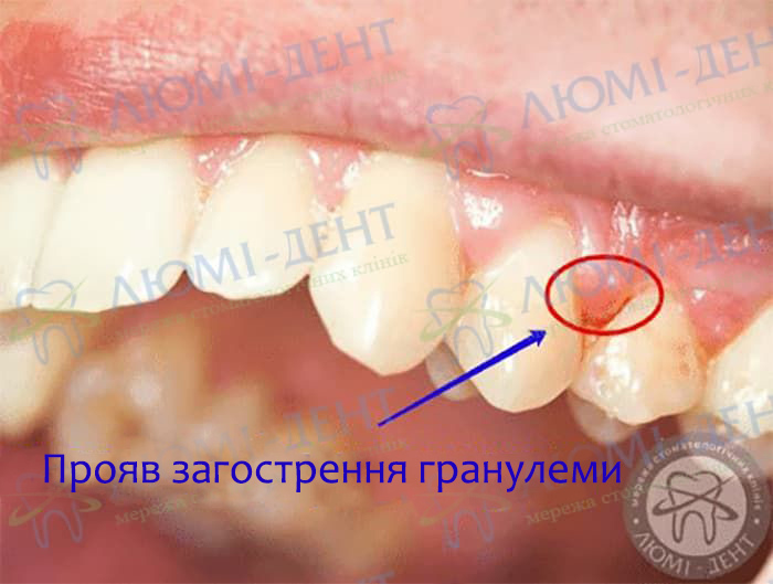 Що таке гранулема зуба фото Люмі-Дент