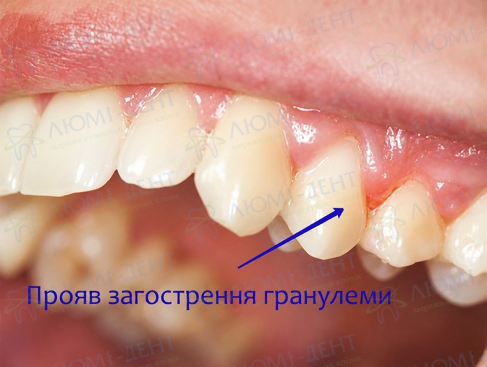 Клінічний прояв загострення гранульоми біля верхівки кореня зуба Клінічний прояв загострення гранульоми біля верхівки кореня зуба