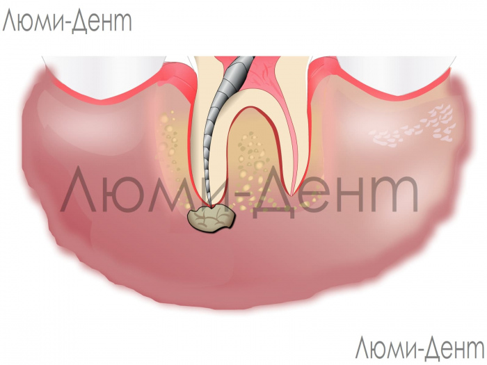 Лечение гранулемы зуба фото Киев Люмидент 