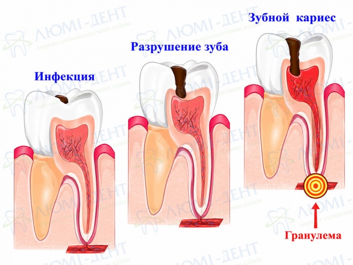 Схема развития воспаления у верхушки корня зуба Схема развития воспаления у верхушки корня зуба