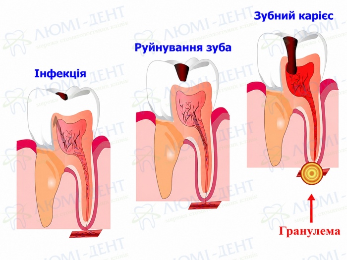 Схема розвитку запалення біля верхівки кореня зуба Схема розвитку запалення біля верхівки кореня зуба
