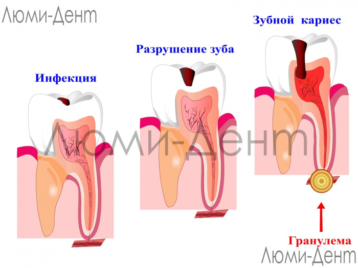 Гранулема зуба фото Люми-Дент