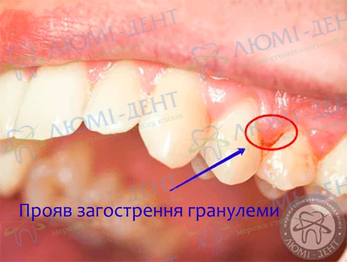 гранульома зуба фото Люмі-Дент