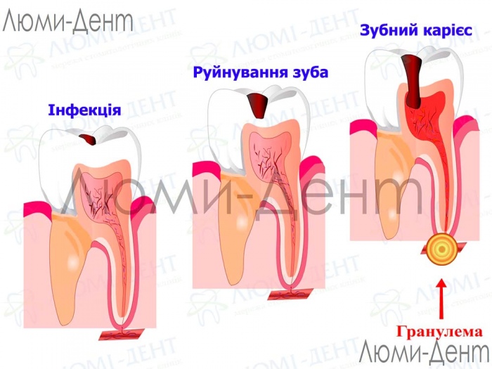 гранульома фото Люмі-Дент