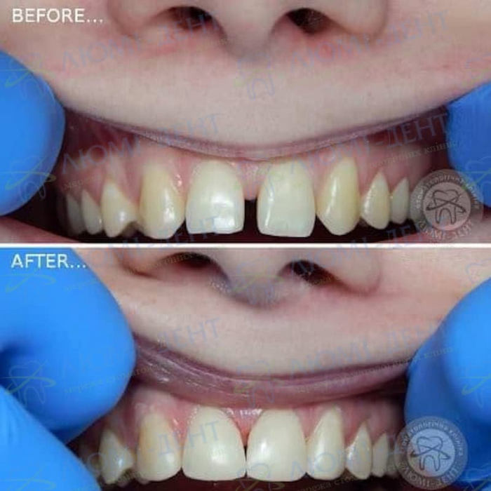 Художня реставрація щілини між зубами Люмідент