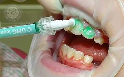 Имплантация эмали Icon укрепление зубов фото Люми-Дент 