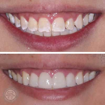 Восстановление эмали зубов фото Люми-Дент 