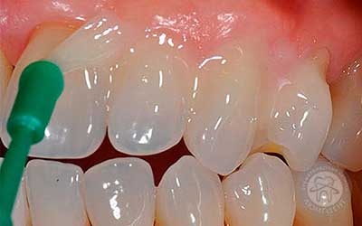 покриття зубів емаллю фото Люмі-Дент