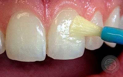 Укрепление эмали зубов имплантация Люми-Дент фото