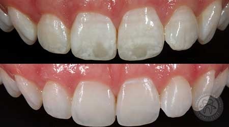 відновлення зубної емалі зміцнення зубів фото Люмі-Дент