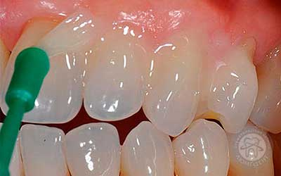 Відновлення зміцнення зубної емалі лікування фото Люмі-Дент