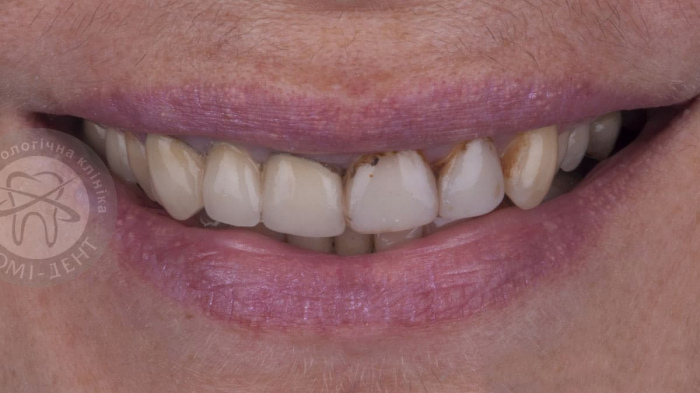 Відновлення зубної емалі зубів лікування Люмі-Дент фото