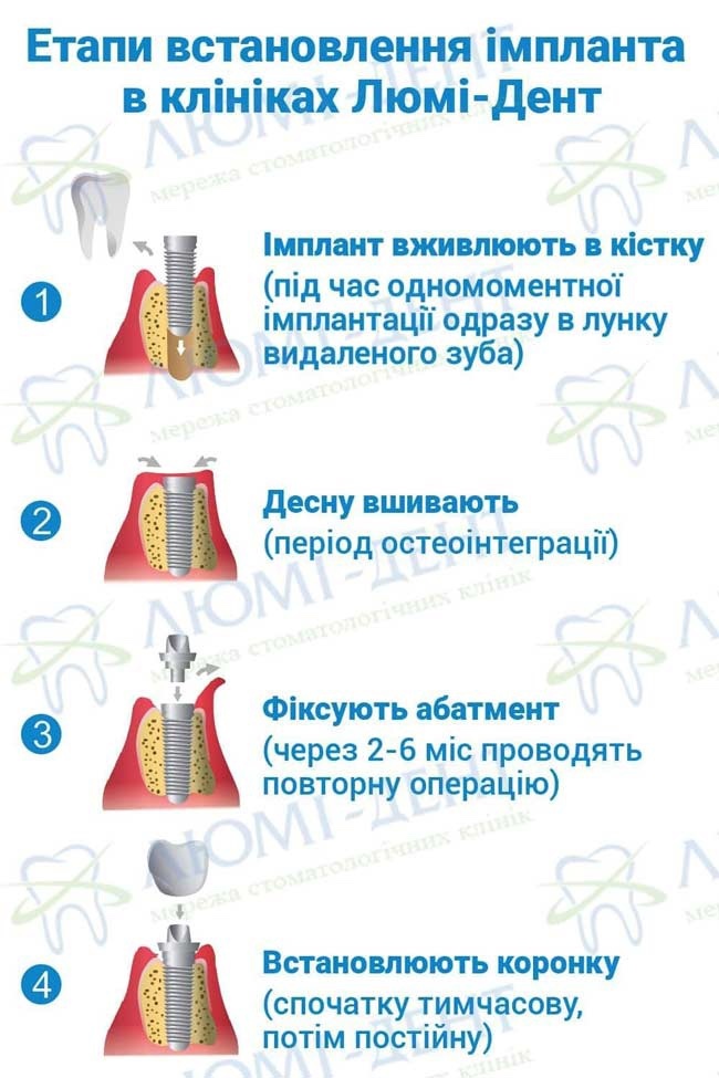 Імплантація зубів етапи ЛюміДент