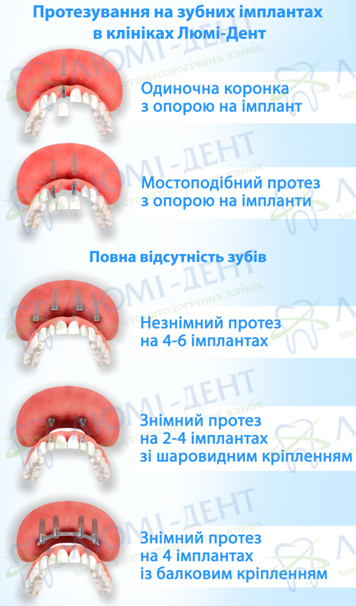 Імплантація зубів протезування фото ЛюміДент